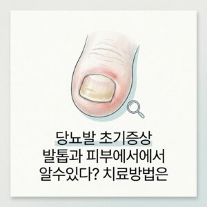 당뇨발 초기증상 발톱과 피부에서에서 알수있다? 치료방법은